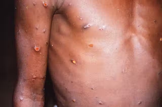 Monkeypox