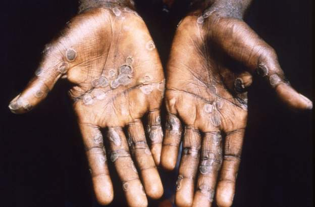 Monkeypox symptoms include an itchy rash and lesions mainly on hands and feet Monkeypox symptoms include an itchy rash and lesions mainly on hands and feet