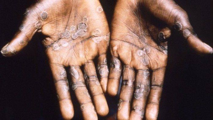 Monkey Pox