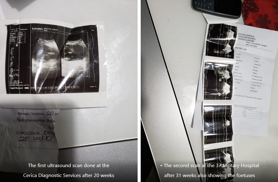 Missing twins saga: 37 Military Hospital apologises to couple …claims scans were incorrect Missing twins saga: 37 Military Hospital apologises to couple …claims scans were incorrect