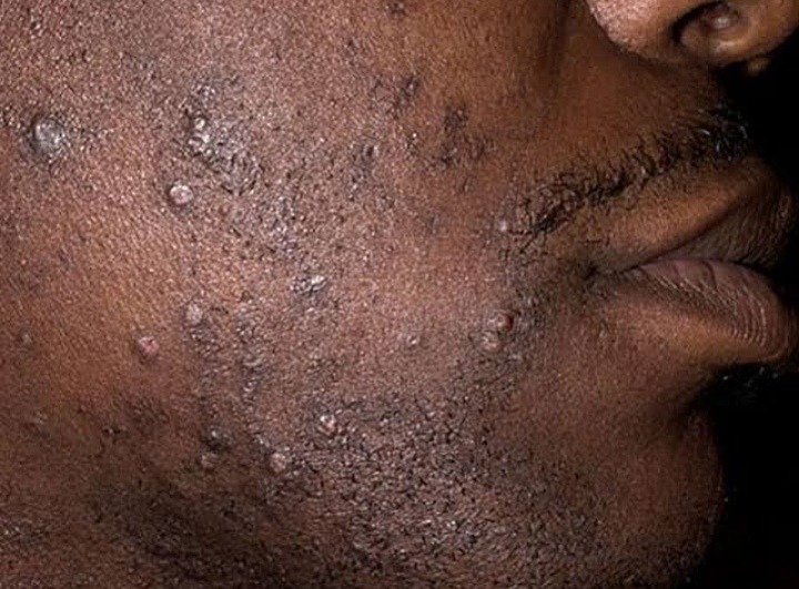 how to get rid of pimples after shaving my beard