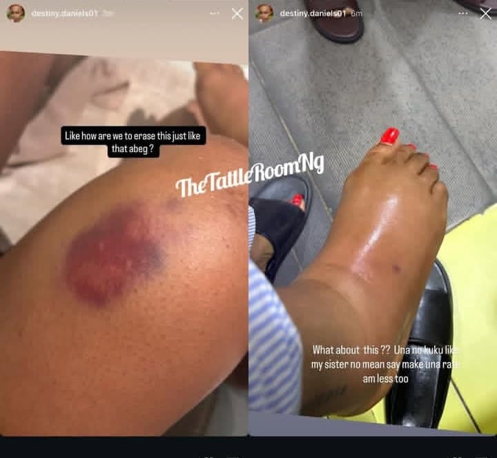 Destiny Daniels shares photo of Regina Daniels scars