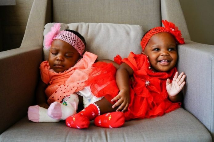 Conjoined twins survive 27-hour intense surgery