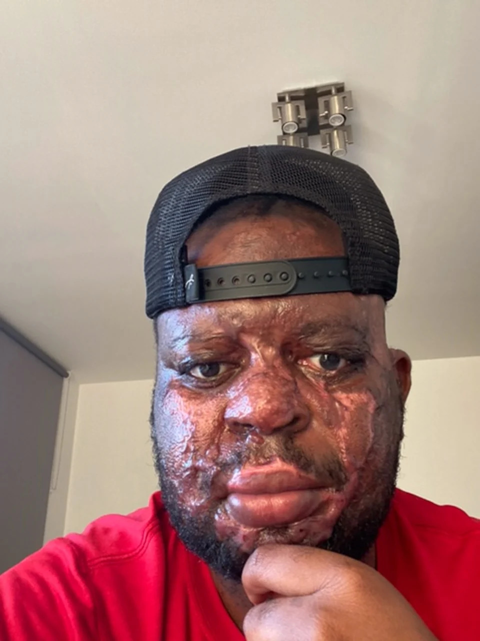 Jealous Ghanaian woman in UK jailed for pouring acid on boyfriend over mistaken cheating fears Kelvin Pogo suffered extensive burns to his face and body (Kelvin Pogo)
