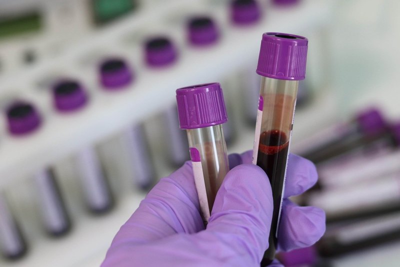 Researchers found the test did a good job of pinpointing which blood samples came from cancer patients, including those who had early-stage cancer. Photo by Belova59/Pixabay