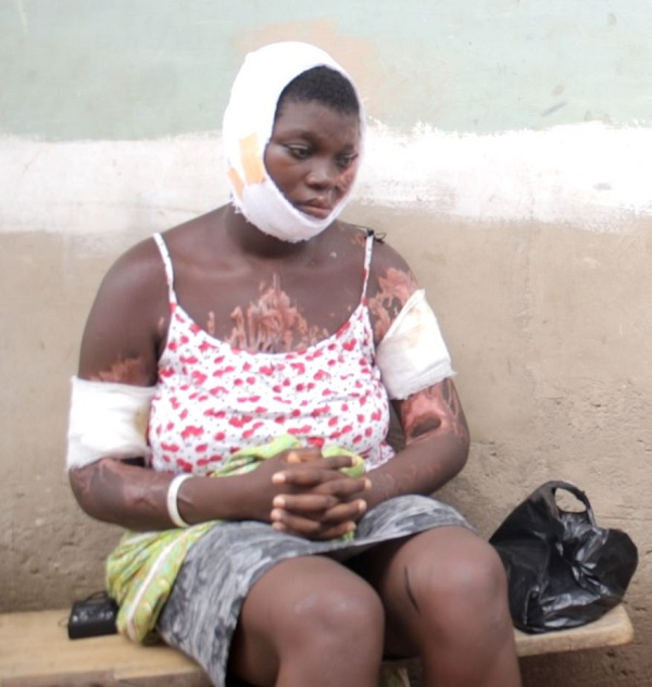 Disfigured Grace Amezando is struggling to get proper medical care