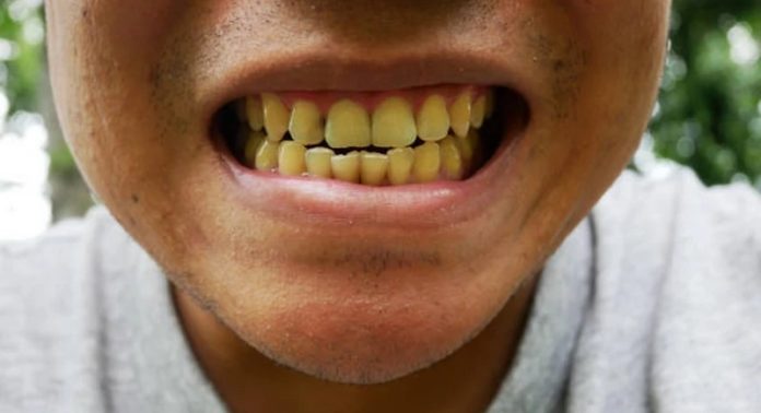 5 effective ways to get rid of yellow teeth