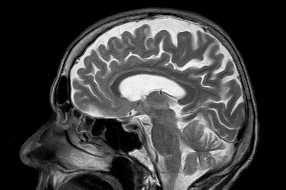 Mild brain injury leads to early cognitive decline, study in veterans finds