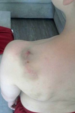 This photo, which was issued by West Midlands Police, shows bruises on Arthur Labinjo-Hughes' back