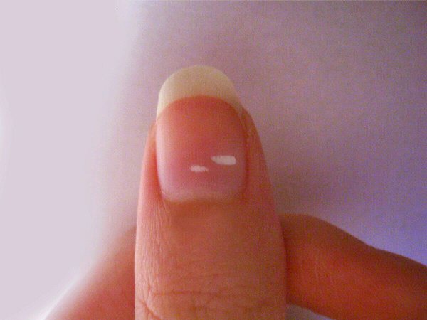 What These White Spots On The Fingernails Means 