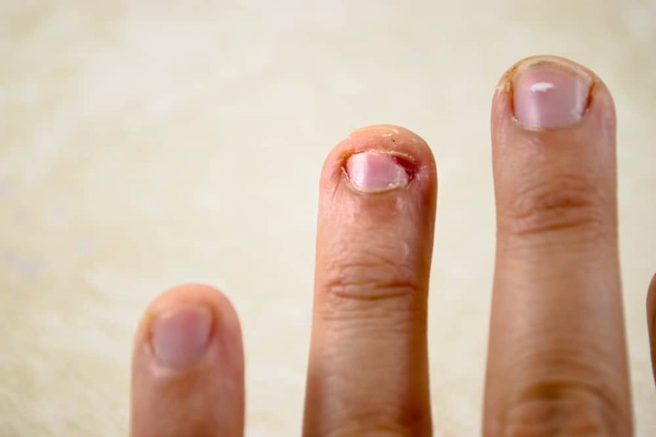 Don't Bite Your Nails Again. Check out 5 reasons to stop biting your nails.  