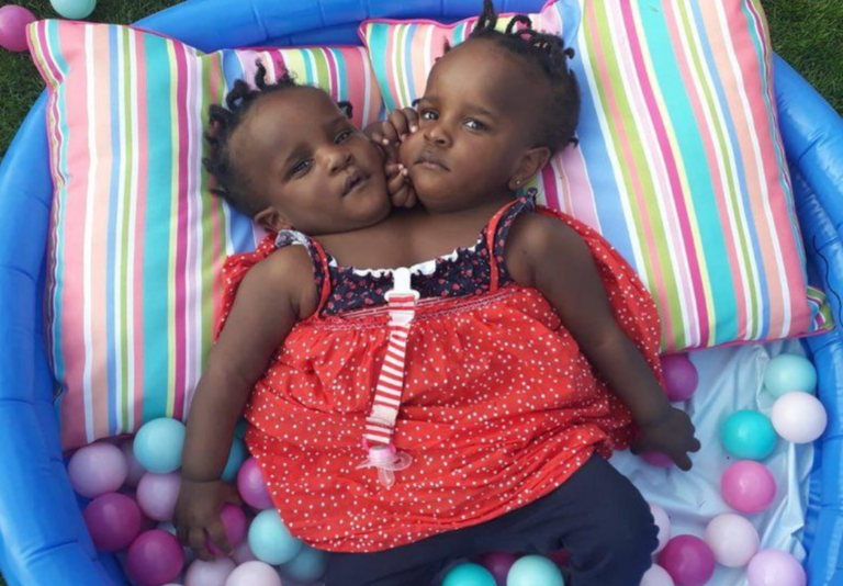 Miracle Twins: Conjoined siblings given days to live beat the odds, flourish