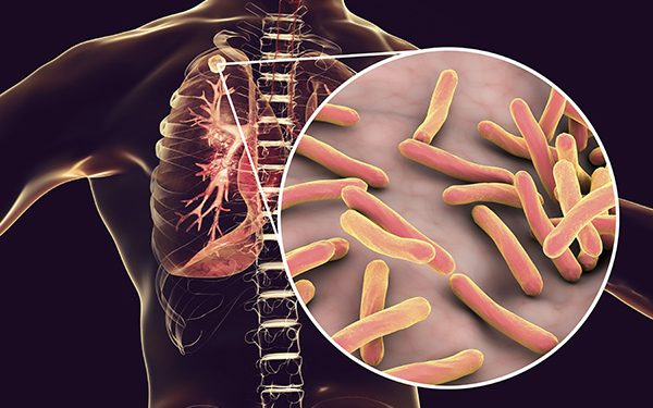 Public caution against stigma, misconception, and myth about TB