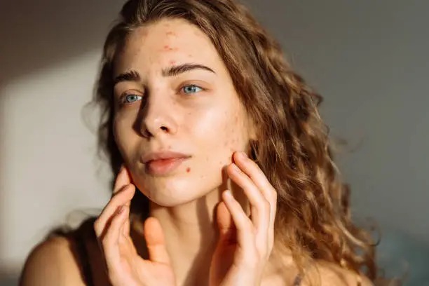 How To Remove Blemishes From The Face