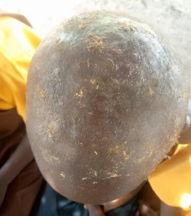 Skin disease outbreak leaves Mepe-Avetakpo residents in agony