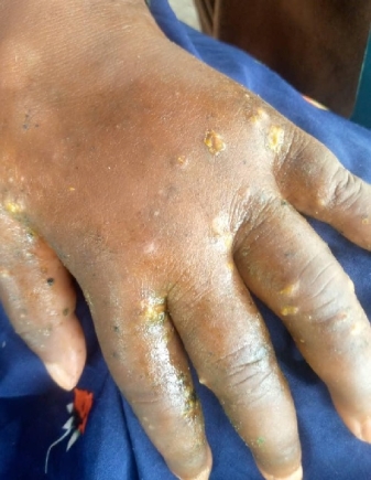 Skin disease outbreak leaves Mepe-Avetakpo residents in agony