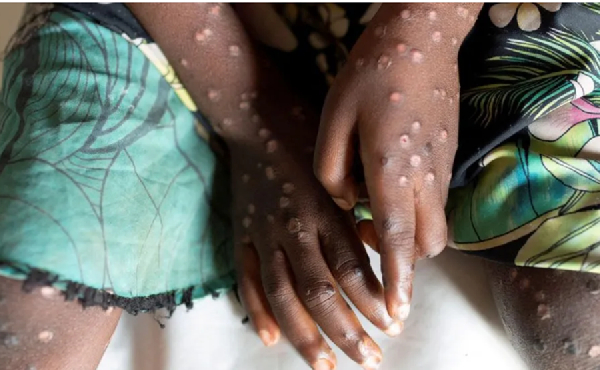 Monkeypox cases in Ghana rise to 9