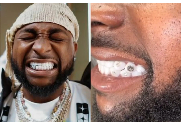 Davido reveals diamond teeth worth $500K, chain valued at $2 million