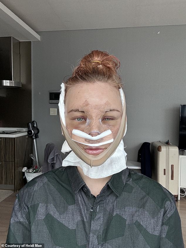 Heidi tells the Daily Mail she 'knew full well that there was going to be backlash' for her facelift