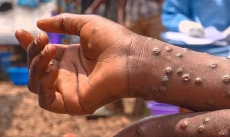 Keta Health Directorate urges residents to practice personal hygiene to prevent Mpox