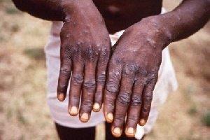 Western Region accounts for 71% of confirmed Mpox cases