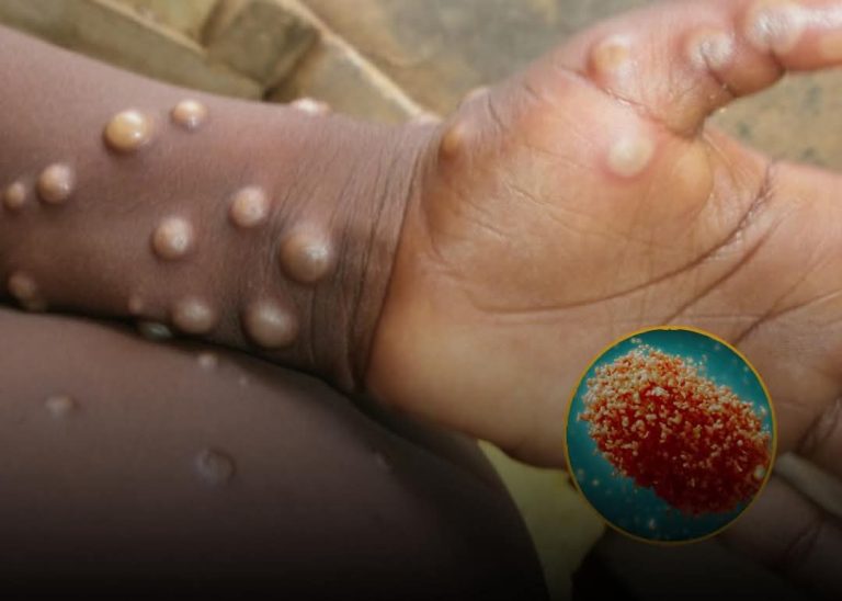 Ghana confirms 26 new Mpox cases; total infections rise to 45  