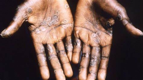 Ghana records 6 new Mpox cases, total rises to 91