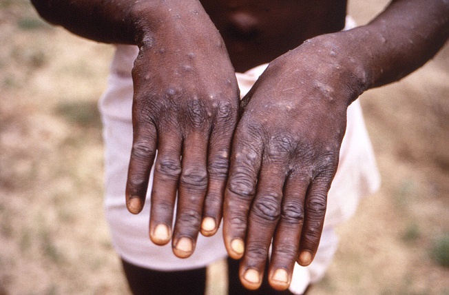 Mpox Cases Rise To 85