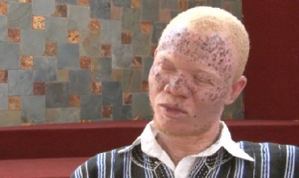 Albinos cry to government over the high cost of suncream