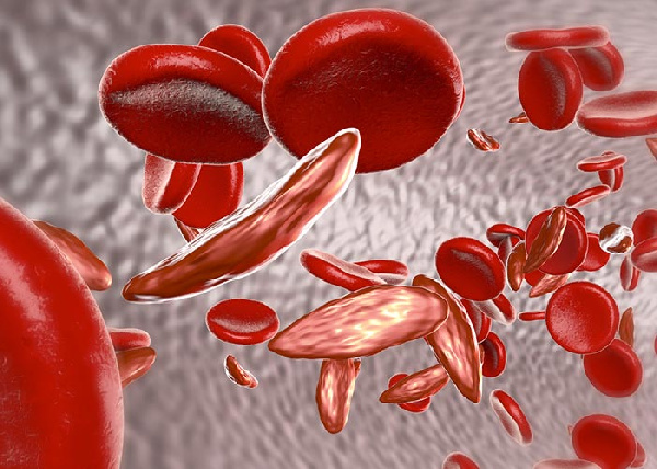 Ghana must look beyond the physical pain of sickle cell disease