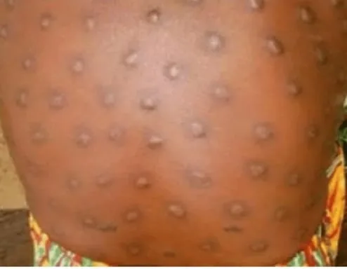 Asukawkaw communities record increase in blackfly bites